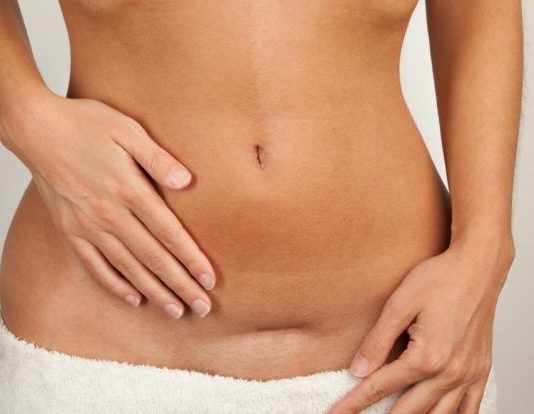 Il cesareo: come viene vissuto dalle gravide